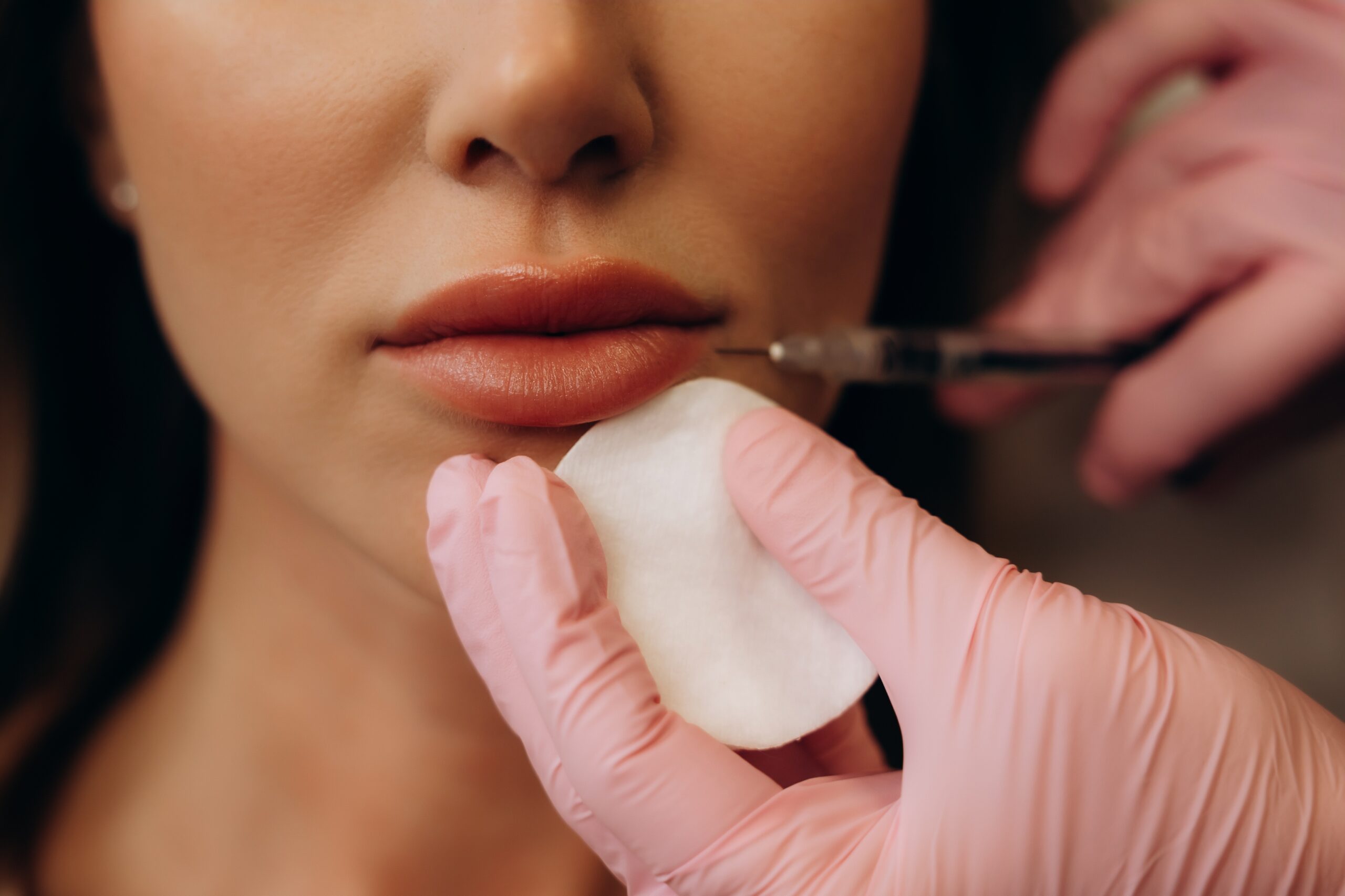 Lip Filler Corrections