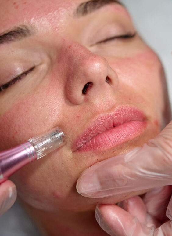 PRP Microneedling