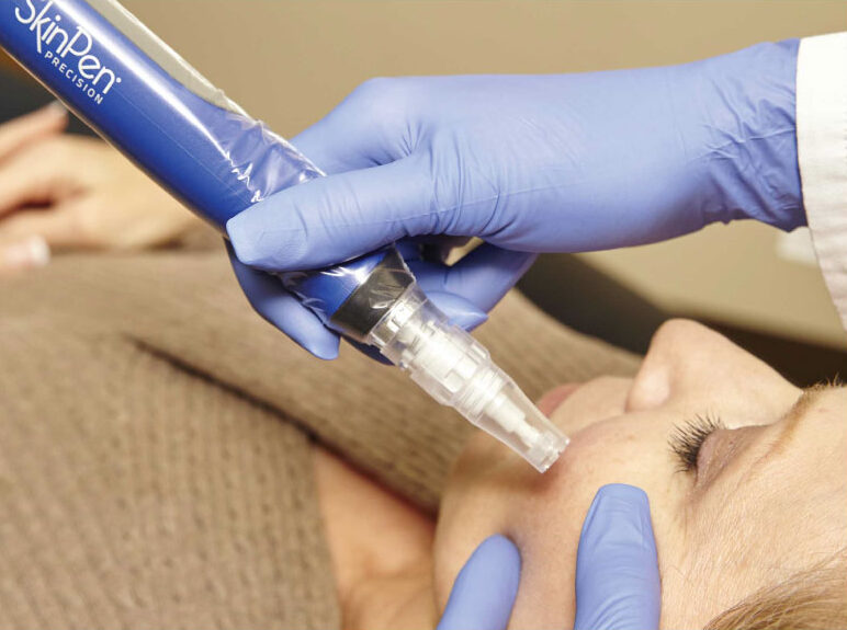 SkinPen Microneedling