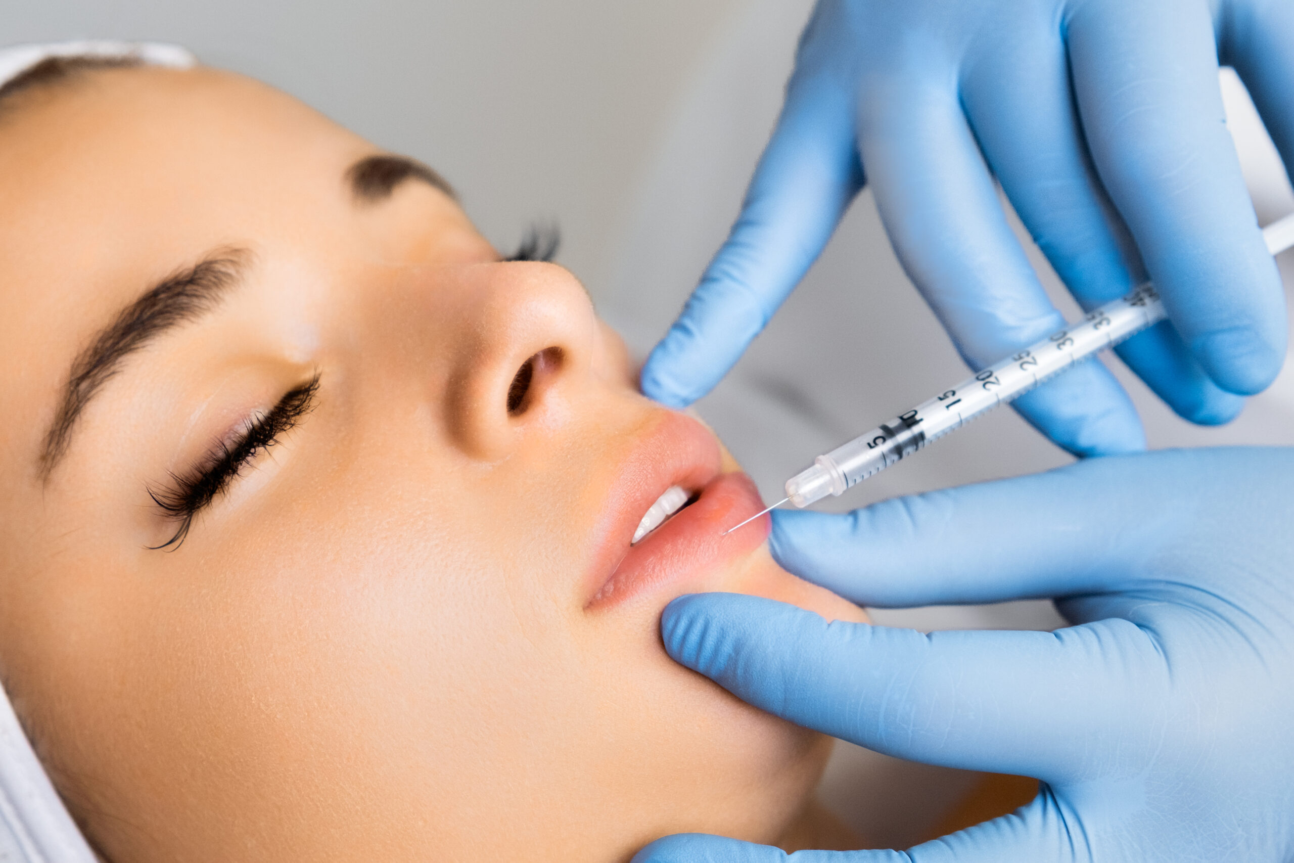 Lip Filler